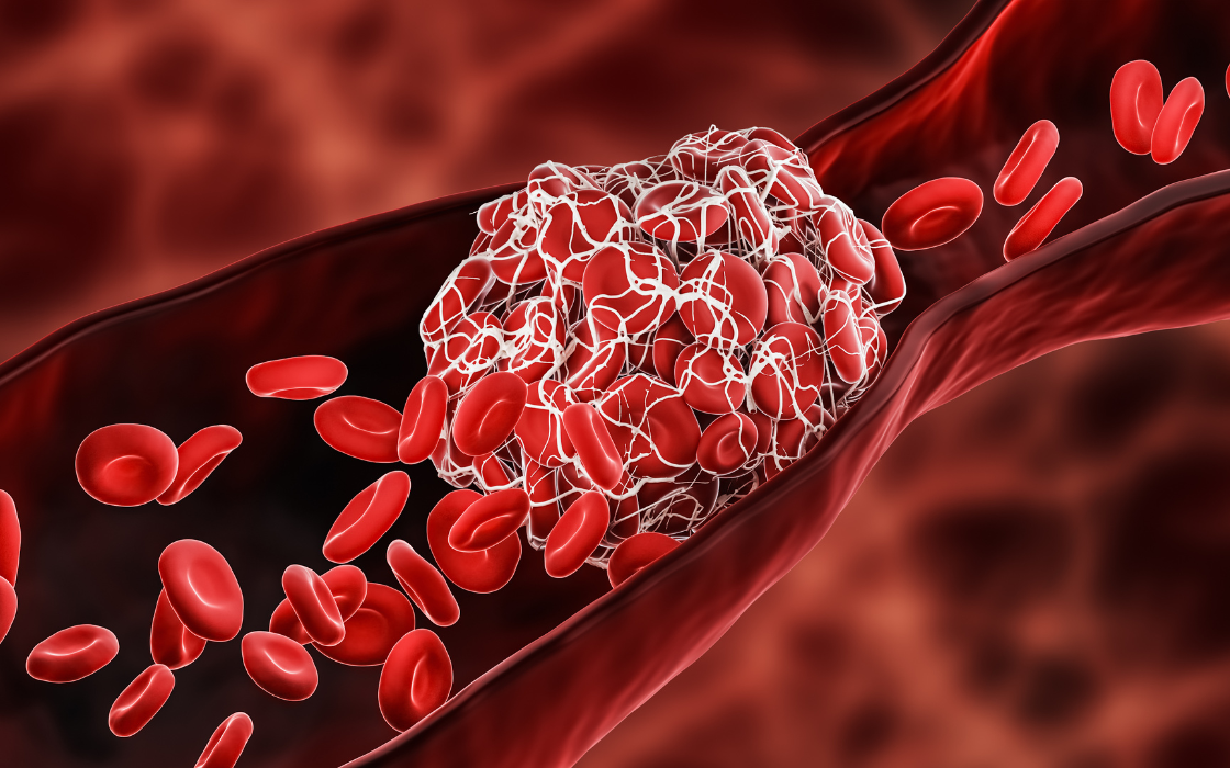 Blood clots in the blood vessels are among the most common causes of heart attack and stroke